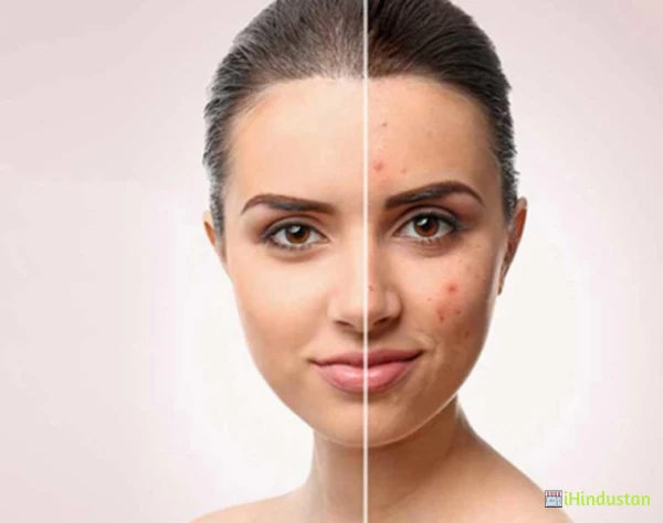 Best Acne scars treatments in Hyderabad - Logo