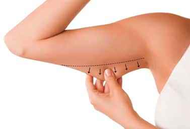 Best Body Lift Surgery - Cover photo