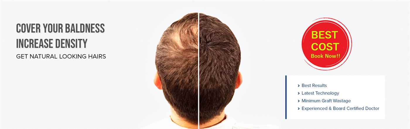 Best Hair Transplant Surgeon - Cover photo