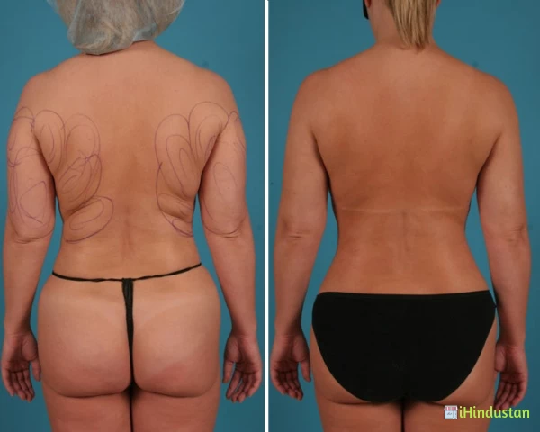 Best Liposuction in Delhi - Logo