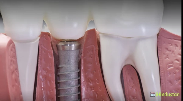 Deep Dental Implant Centre - Logo