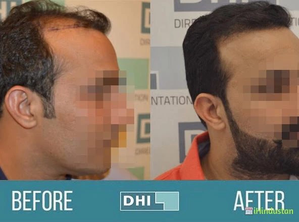 DHI™ India - Best Hair Transplant Clinic in Delhi - Logo