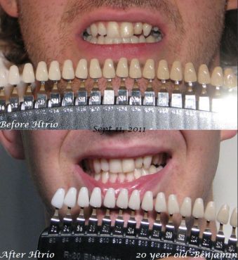 First Impression Teeth Whitening - Cover photo