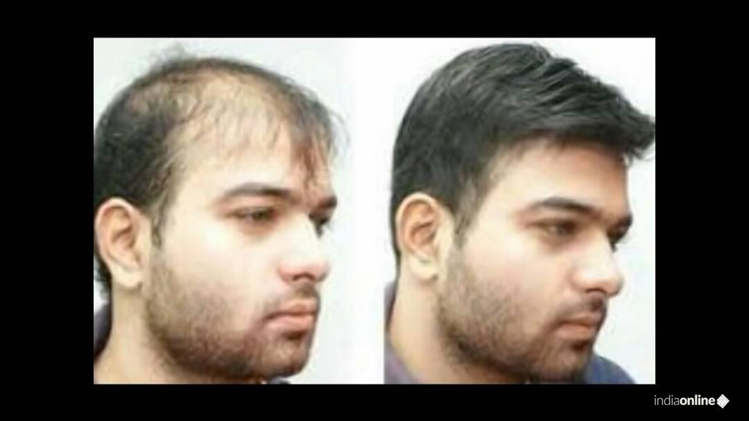 Hairline India - Cover photo