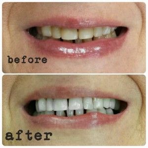 H-Smile Teeth Whitening and Dental Hygiene - Logo