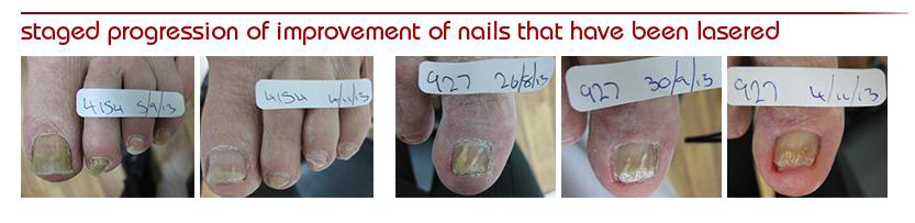 Kingscliff Podiatry Laser Clinic - Logo
