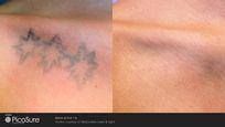 Liberty Tattoo Removal - Cover photo
