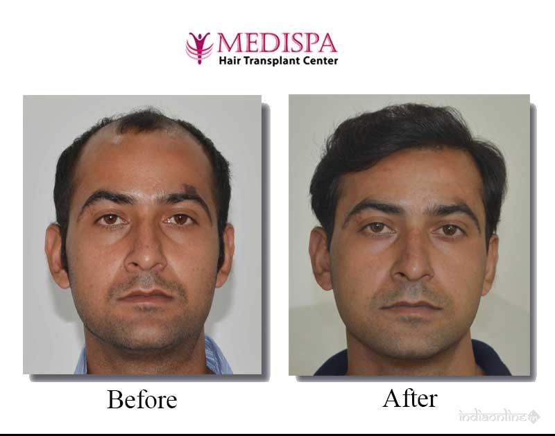 Medispa Hair Transplant Center - Cover photo