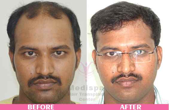 Medi Spa Medispa Hair Transplant Clinic - Cover photo