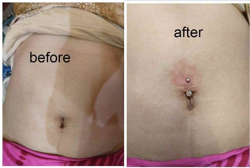 Navel Piercing Sri Ganganagar - Cover photo