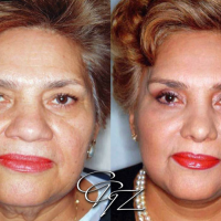 Plastic Surgery Medical Tourism to Mexico - Cover photo