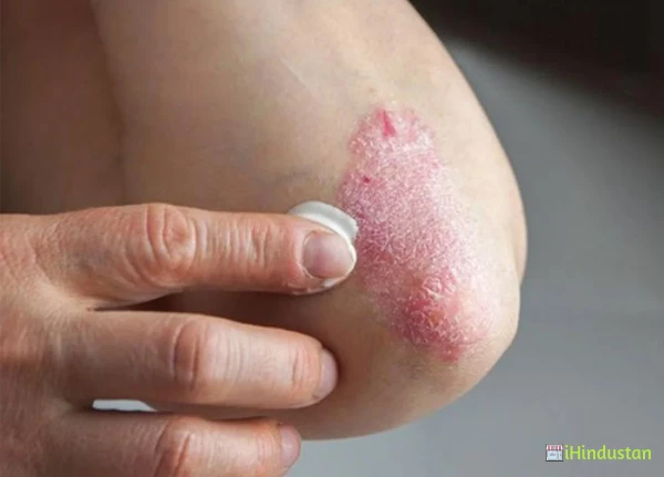 Psoriasis Treatment in Hyderabad - Logo