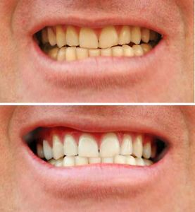 Teeth Whitening - Logo