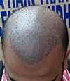 Walia Hair Transplant - Cover photo